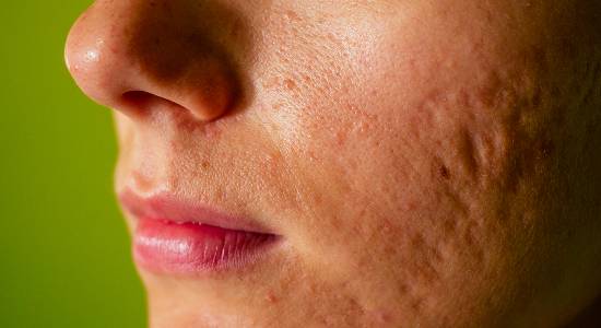 Pigmentation & Acne Treatments-img